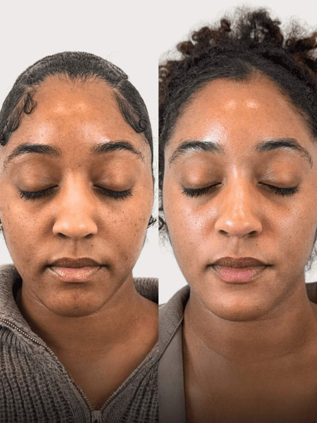 Resultado antes y después - Reducción de arrugas