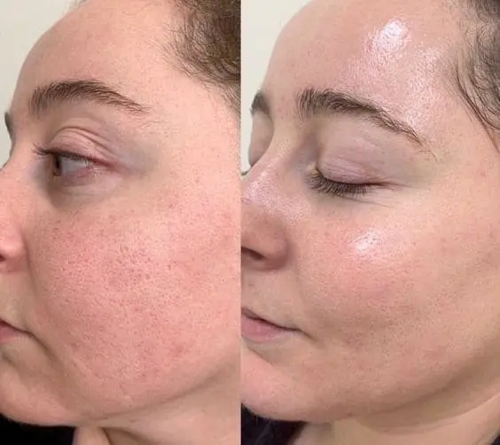 Resultado tratamiento microneedling